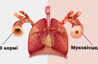 Чи можна вилікувати муковісцидоз: сучасні підходи та перспективи лікування