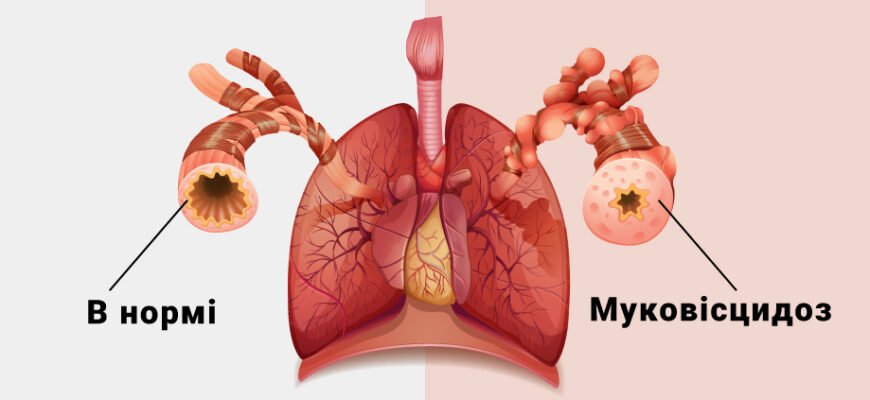 Чи можна вилікувати муковісцидоз: сучасні підходи та перспективи лікування