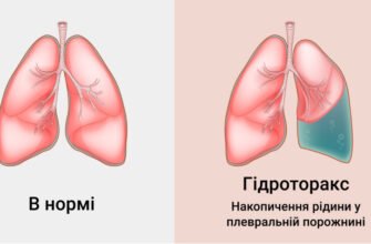 “Вода в легенях: наслідки та ризики для вашого здоров’я”