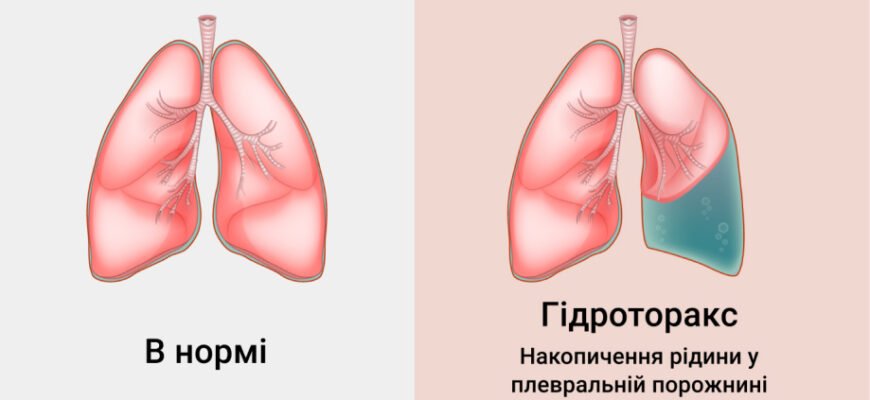 “Вода в легенях: наслідки та ризики для вашого здоров’я”