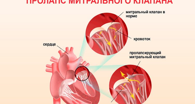 Чи можна вилікувати пролапс мітрального клапана: сучасні методи та поради