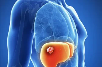 Чи можна вилікувати метастази в печінці: сучасні підходи та методи лікування