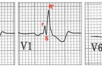 Повна блокада правої ніжки пучка Гіса: наслідки і ризики здоров’я
