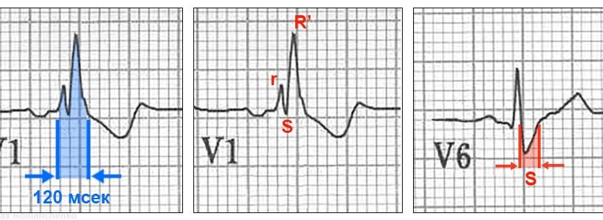 Повна блокада правої ніжки пучка Гіса: наслідки і ризики здоров’я