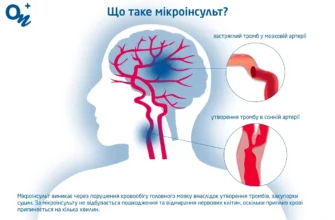 “Мікроінсульт: Наслідки, Які Варто Знати для Збереження Здоров’я”