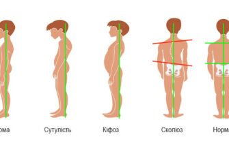 Наслідки сколіозу: як він впливає на здоров’я та життя людини