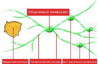 Біопсія лімфовузла: наслідки, що потрібно знати для здоров’я