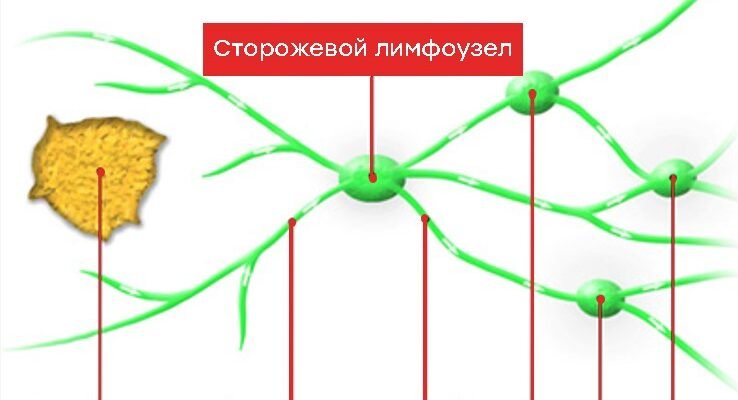 Біопсія лімфовузла: наслідки, що потрібно знати для здоров’я