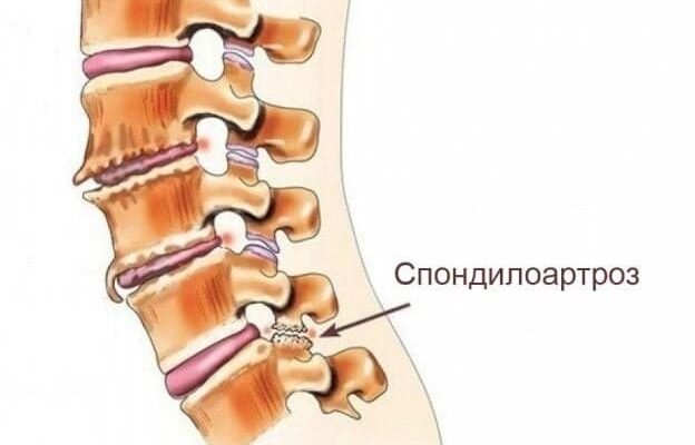 Чи можна вилікувати спондилоартроз: сучасні методи та поради лікарів