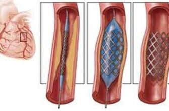 Наслідки після стентування: важливі аспекти відновлення та ризики