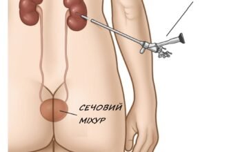 Наслідки після видалення нирки: зміни в організмі та адаптація