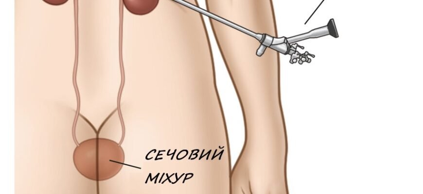 Наслідки після видалення нирки: зміни в організмі та адаптація