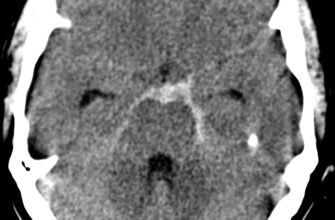 Комплексний огляд: наслідки субарахноїдального крововиливу для здоров’я