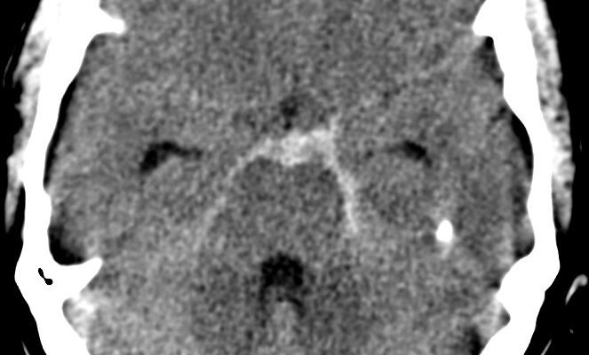 Комплексний огляд: наслідки субарахноїдального крововиливу для здоров’я