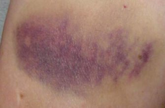 Наслідки гематоми: що варто знати для вашого здоров’я?