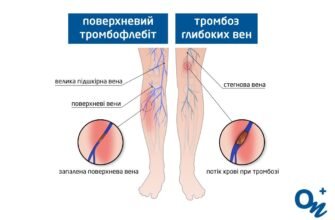 Чи можна ходити при тромбофлебіті: рекомендації та застереження