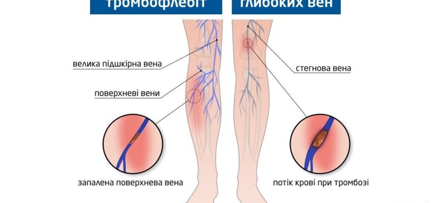 Чи можна ходити при тромбофлебіті: рекомендації та застереження