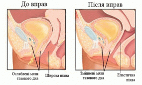 Чи можна їздити на велосипеді при опущенні матки: поради лікарів
