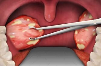 Наслідки видалення гланд: що очікувати після операції?