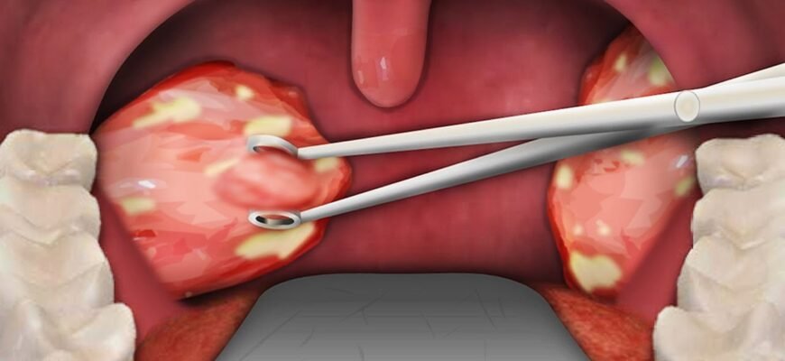 Наслідки видалення гланд: що очікувати після операції?