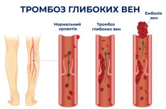 Наслідки тромбозу: ключові ризики та шляхи їх подолання