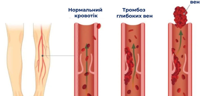 Наслідки тромбозу: як запобігти ускладненням та покращити життя