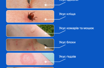“Укус шершня: наслідки для здоров’я та як уникнути ускладнень”