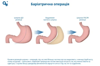 Видалення шлунку: наслідки та як їх подолати для покращення життя