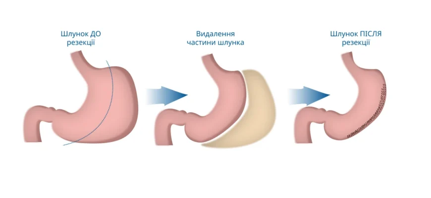 Видалення шлунку: наслідки та як їх подолати для покращення життя