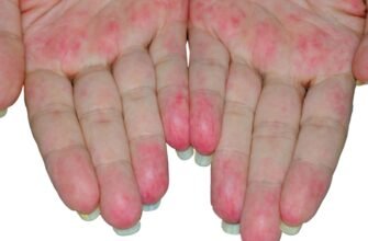 Чи можна вилікувати васкуліт: сучасні методи та перспективи лікування