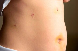 Наслідки після лапароскопії: що очікувати та як уникнути ускладнень