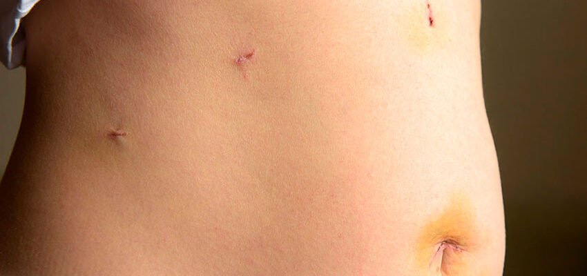 Наслідки після лапароскопії: що очікувати та як їх уникнути?