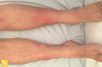 Вузлова еритема: наслідки та вплив на здоров’я пацієнта