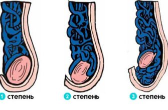 Наслідки операції варикоцеле: що очікувати після втручання?
