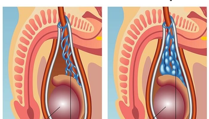 Чи можна мати дітей при варикоцеле: розвінчуємо міфи та факти