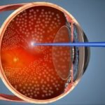 Лазерна коагуляція сітківки: наслідки для зору та відновлення ...