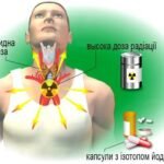 Наслідки після лікування радіоактивним йодом: що важливо знати