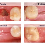 Скільки заживає рана після видалення зуба і як виглядає ✓