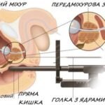 Променева терапія: Наслідки та побічні ефекти для здоров'я пацієнтів