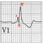 Повна блокада правої ніжки пучка Гіса: наслідки для здоров'я та ...