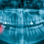 Ускладнення після видалення зуба мудрості • Блог « Dental Guru »