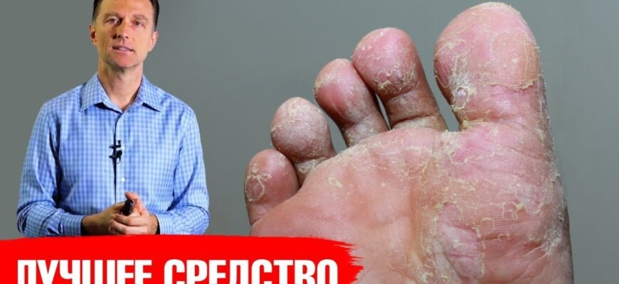 Ефективні методи лікування висипки та свербежу на ногах: поради лікарів