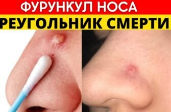 Причини та лікування коричневих виділень з носа: поради лікарів