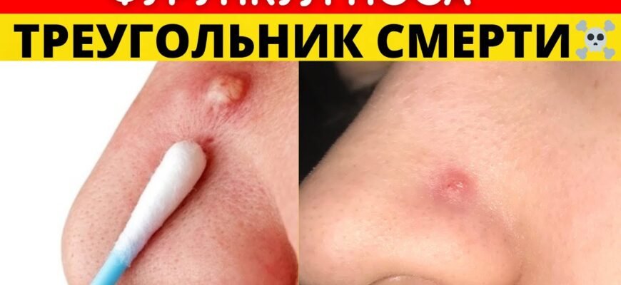 Причини та лікування коричневих виділень з носа: поради лікарів