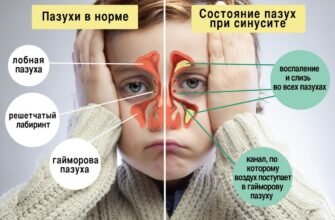 Природа виділень з носа: причини, симптоми та лікування нежитю
