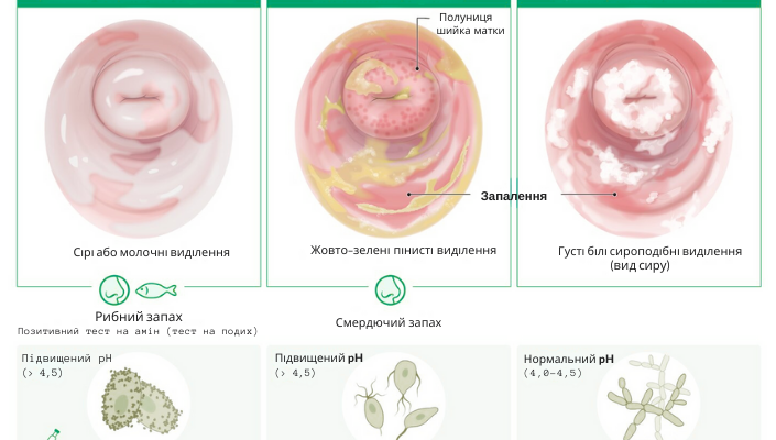 Зелені виділення з піхви без запаху: причини та рекомендації лікарів