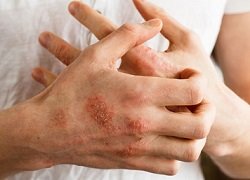 Свербіж шкіри на руках: причини та ефективні способи лікування